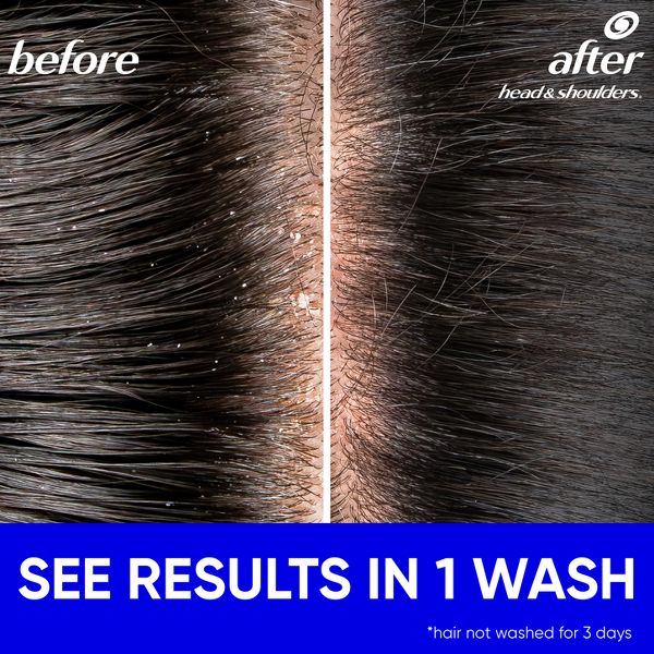 Head & Shoulders Dandruff Shampoo, Anti-Dandruff Treatment, Itchy Scalp Care for Daily Use, Paraben-Free - 20.7 fl oz