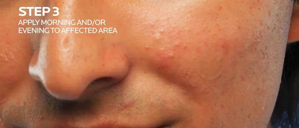 La Roche Posay Effaclar Unspot Acne Pimple Patches - 22ct